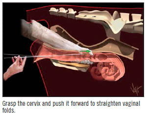 ai generated cervix pull out spread Artificially inseminate in cattle | Engormix