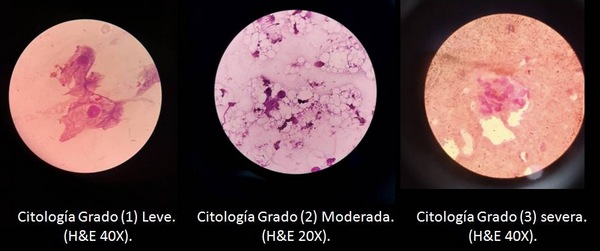 Imágenes microscópicas de citología hepática con distintos grados de severidad.