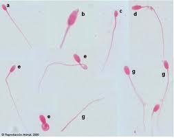 Morfologia espermática del semen - Casos clínicos