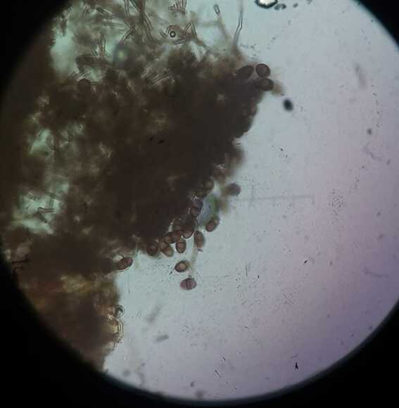 Botryodiplodia theobromae - Casos clínicos